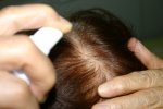 薄毛に効果がある育毛剤、増毛剤の種類・選び方・効果的な使い方。