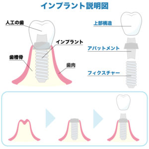 インプラント治療